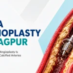 rota angioplasty